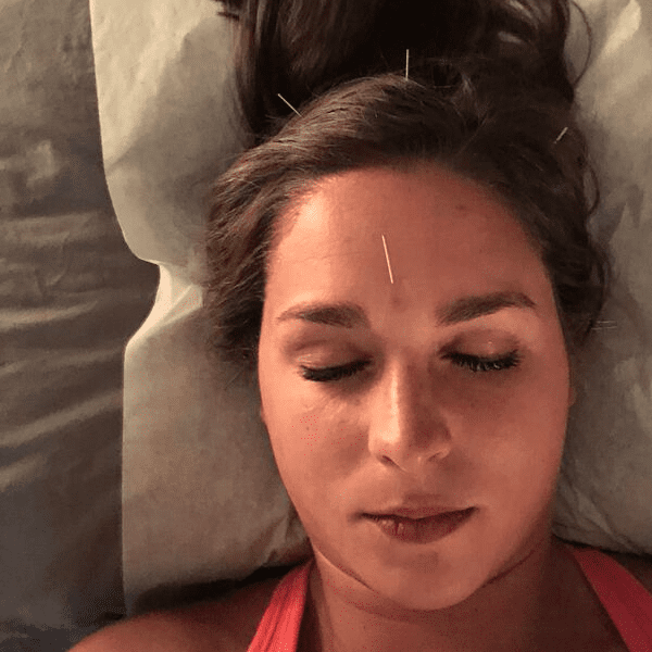 acupuncture in face